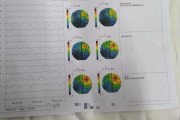 脑电图前景怎么样_脑电图能检查出什么病