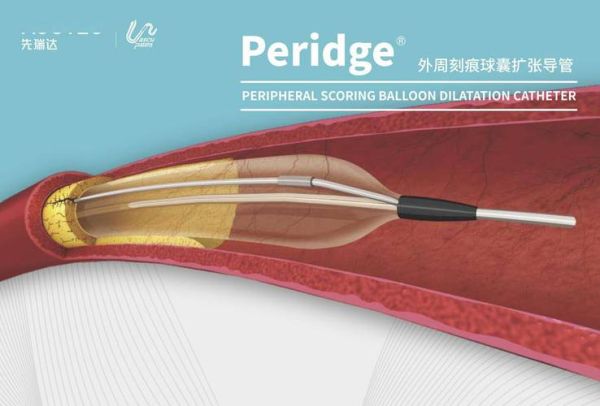 球囊扩张术能维持多久_球囊导管市场未来五年趋势
