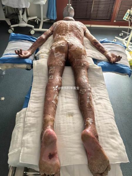 烧伤科就业前景怎么样_烧伤科医生收入高吗