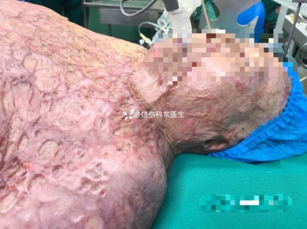 烧伤科就业前景怎么样_烧伤科医生收入高吗