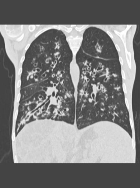 囊性纤维化能治好吗_囊性纤维化最新治疗进展